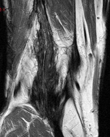 Figure 3 for case aggressive fibromatosis ( RID4292 )